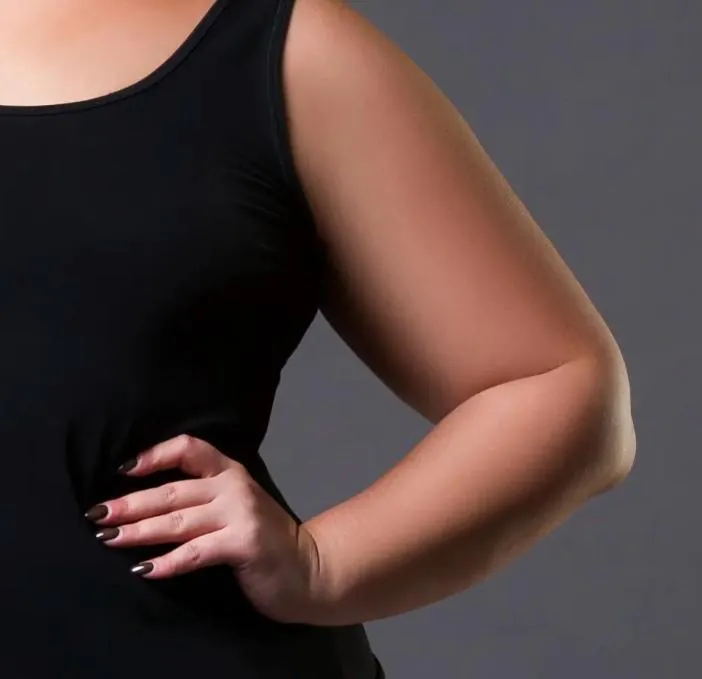 Lipœdème des bras – avant / après liposuccion WAL, photo 1
